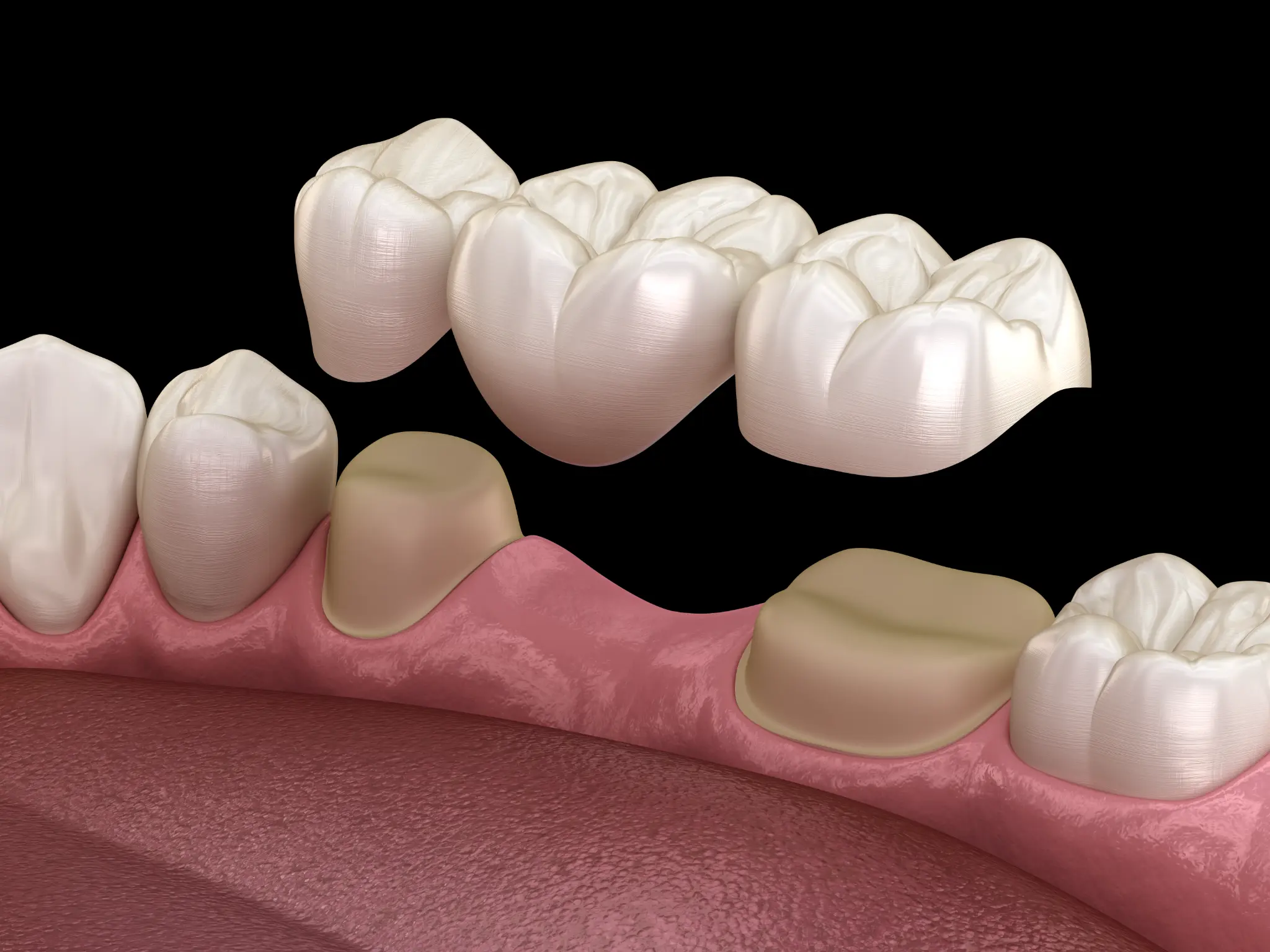 A dental bridge restoring missing teeth