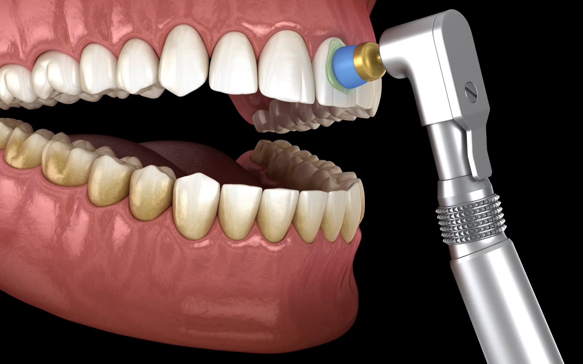Dental polishing during a professional cleaning