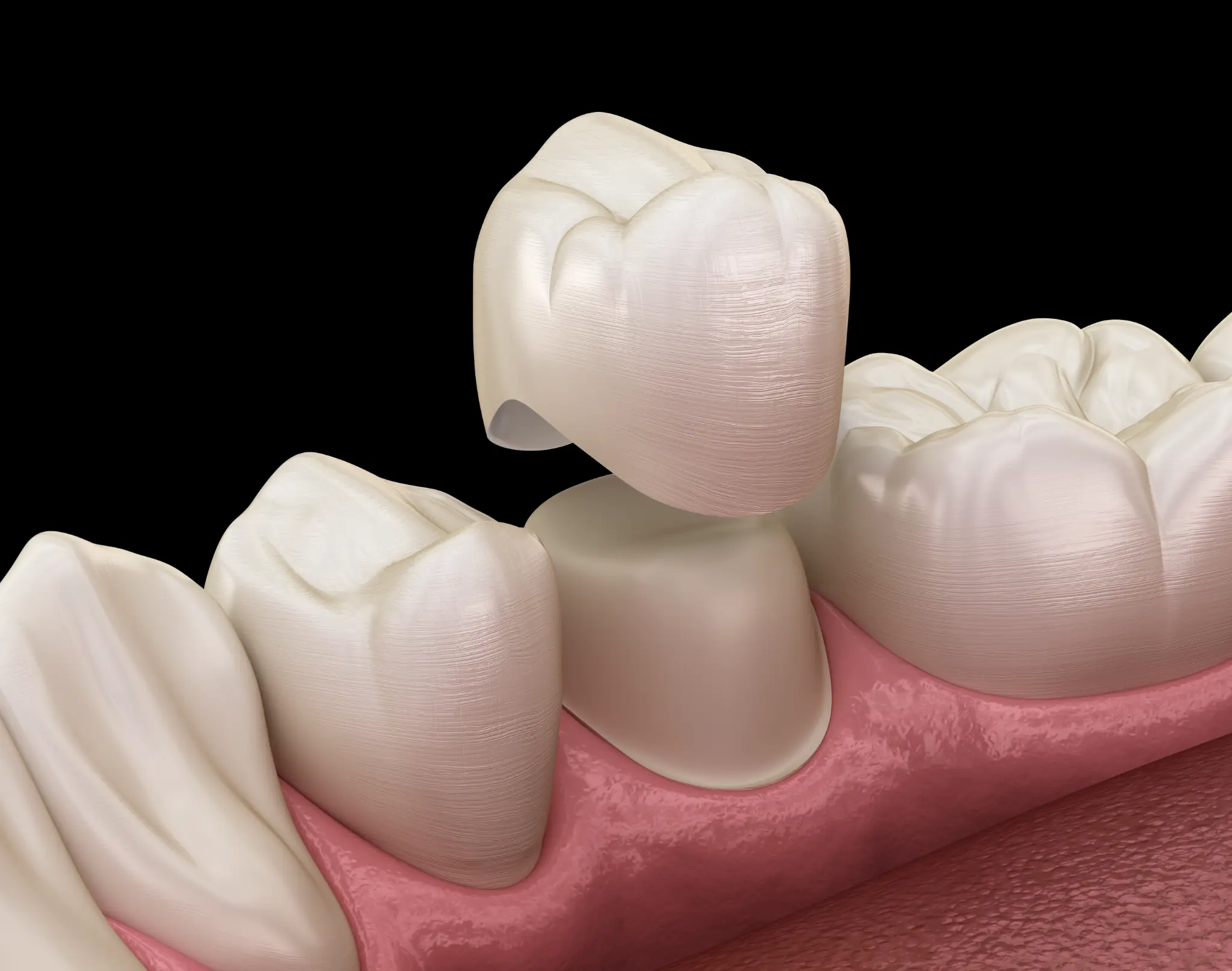A dental crown positioned above a prepared tooth