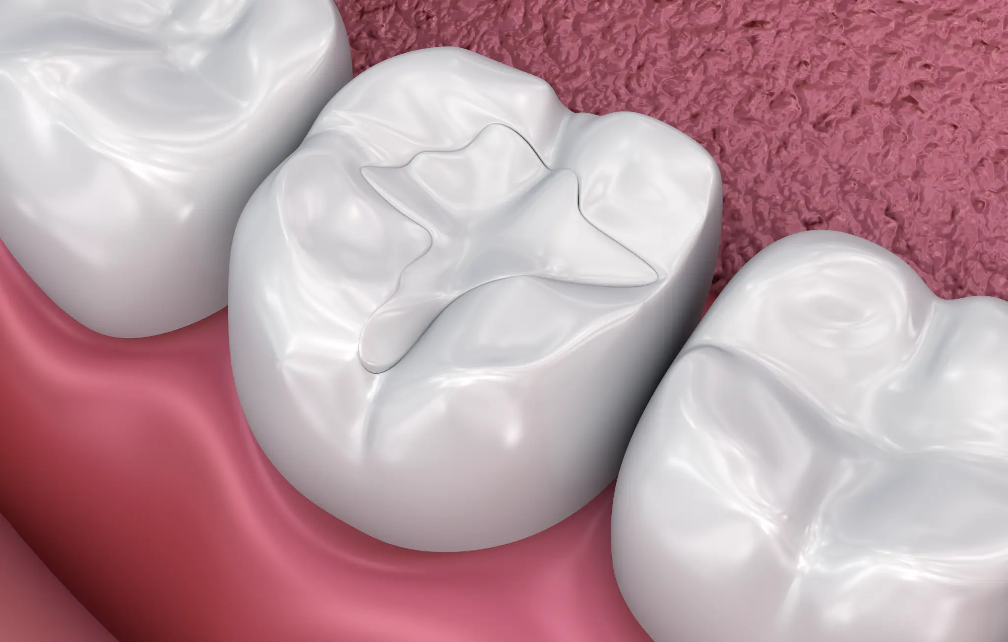 A composite filling restoring the surface of a tooth