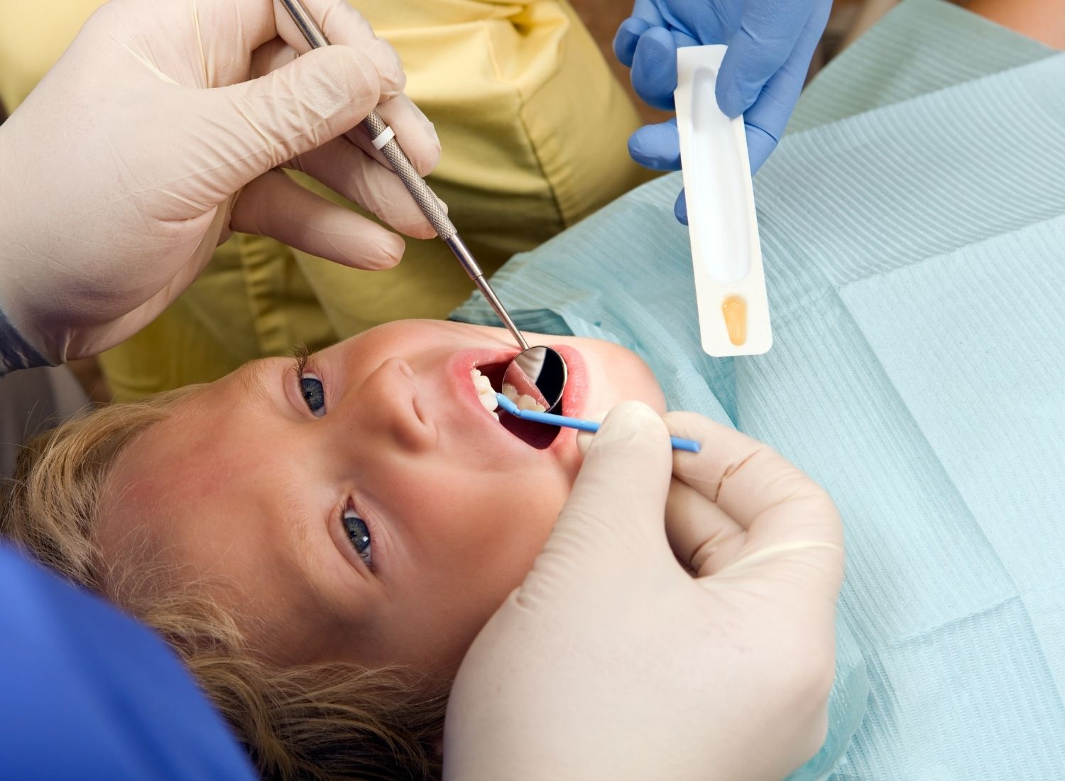 A patient receiving a fluoride treatment during a dental visit
