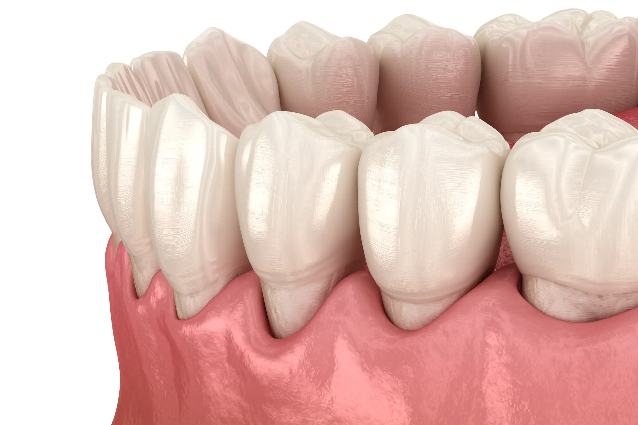 A clinical illustration showing gum recession around the teeth