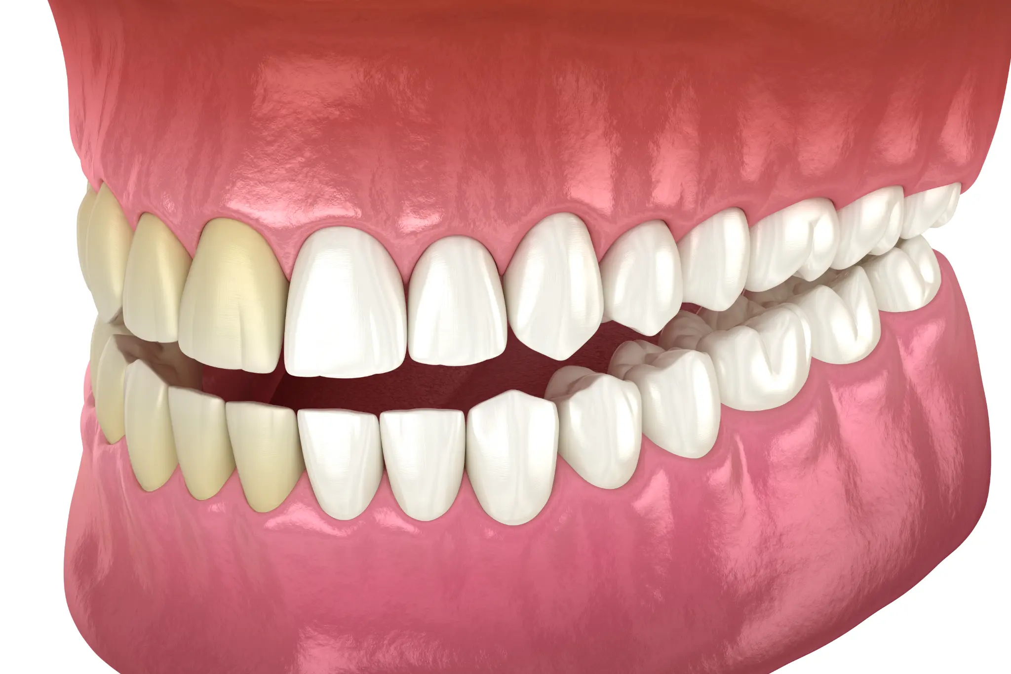 A healthy smile after professional teeth whitening