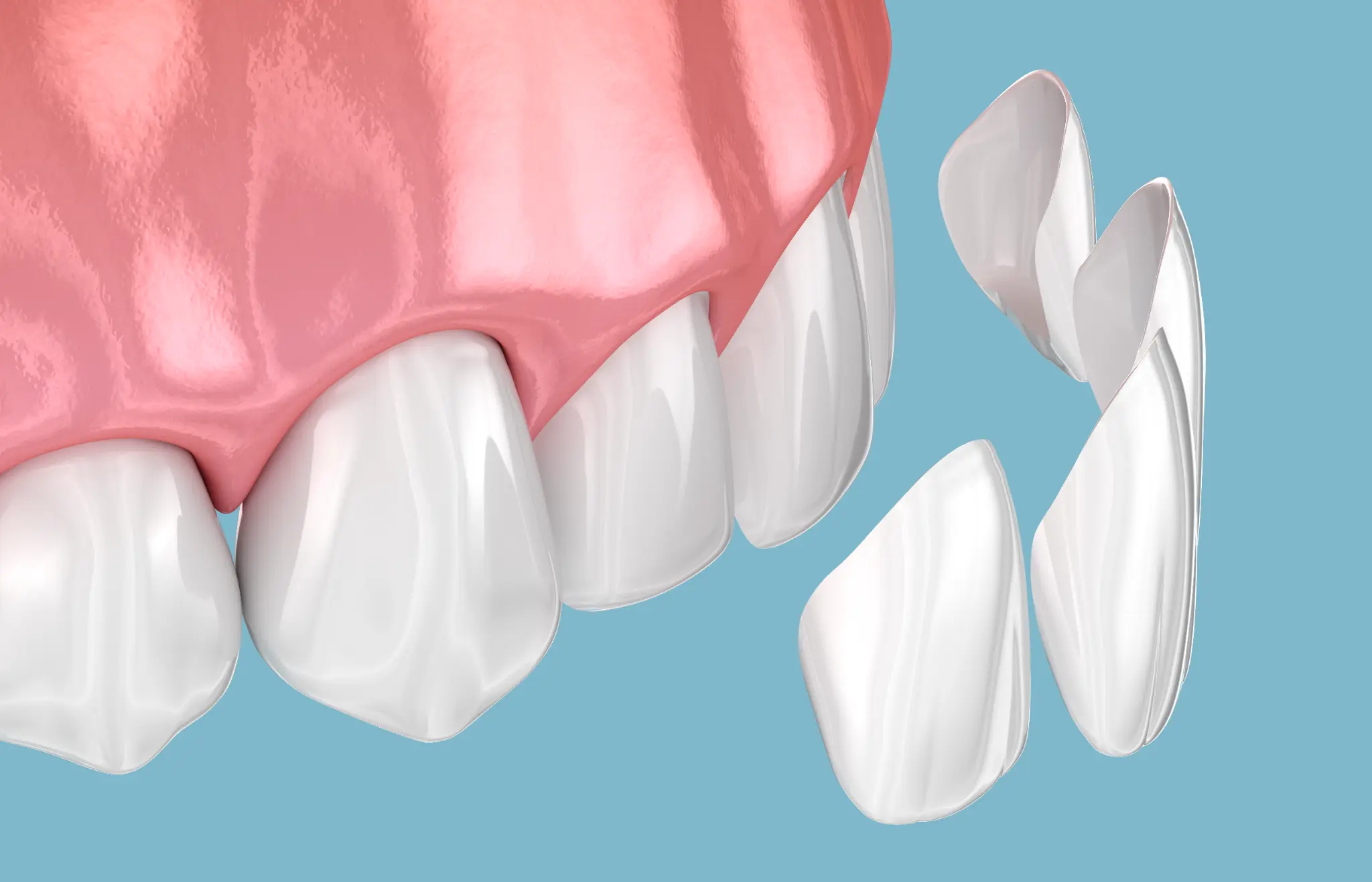 Dental veneers being positioned over front teeth
