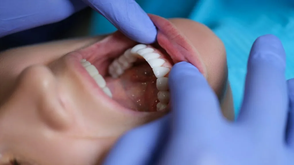 veneers