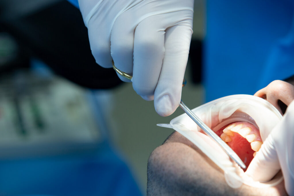 dental resin